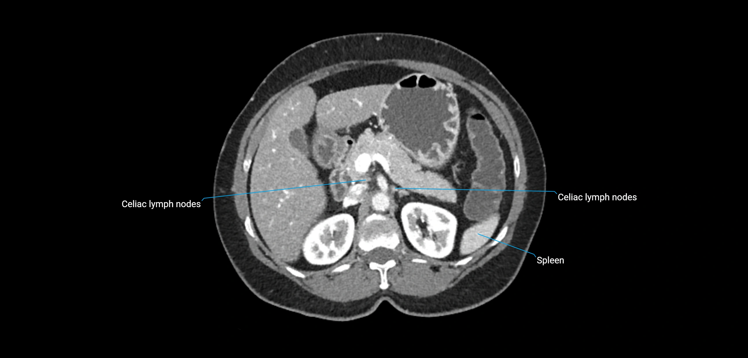 CT ct abdominal lymph nodes  axial cross sectional anatomy  enchanced radiology image -img-00002-00153.webp